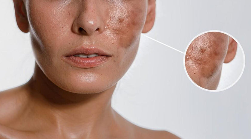 Hyperpigmentation 101: Types, Treatments, and Causes