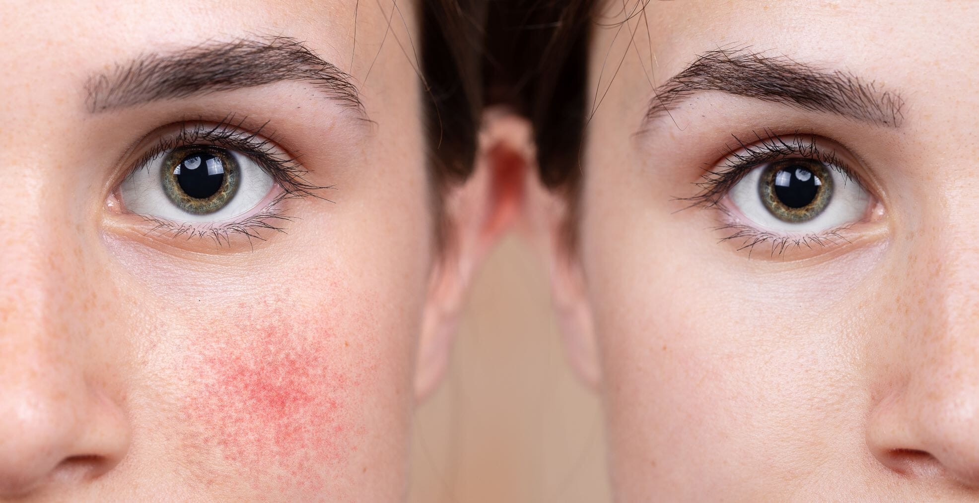 Rosacea & Our PA ~ Paula Lifestyle Tips | Exclusive Beauty Club