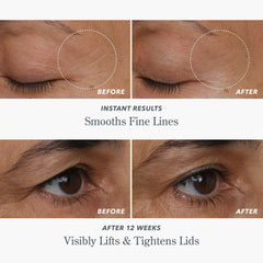 Before and after photos showing smoothed fine lines and lifted tightened eyelids
