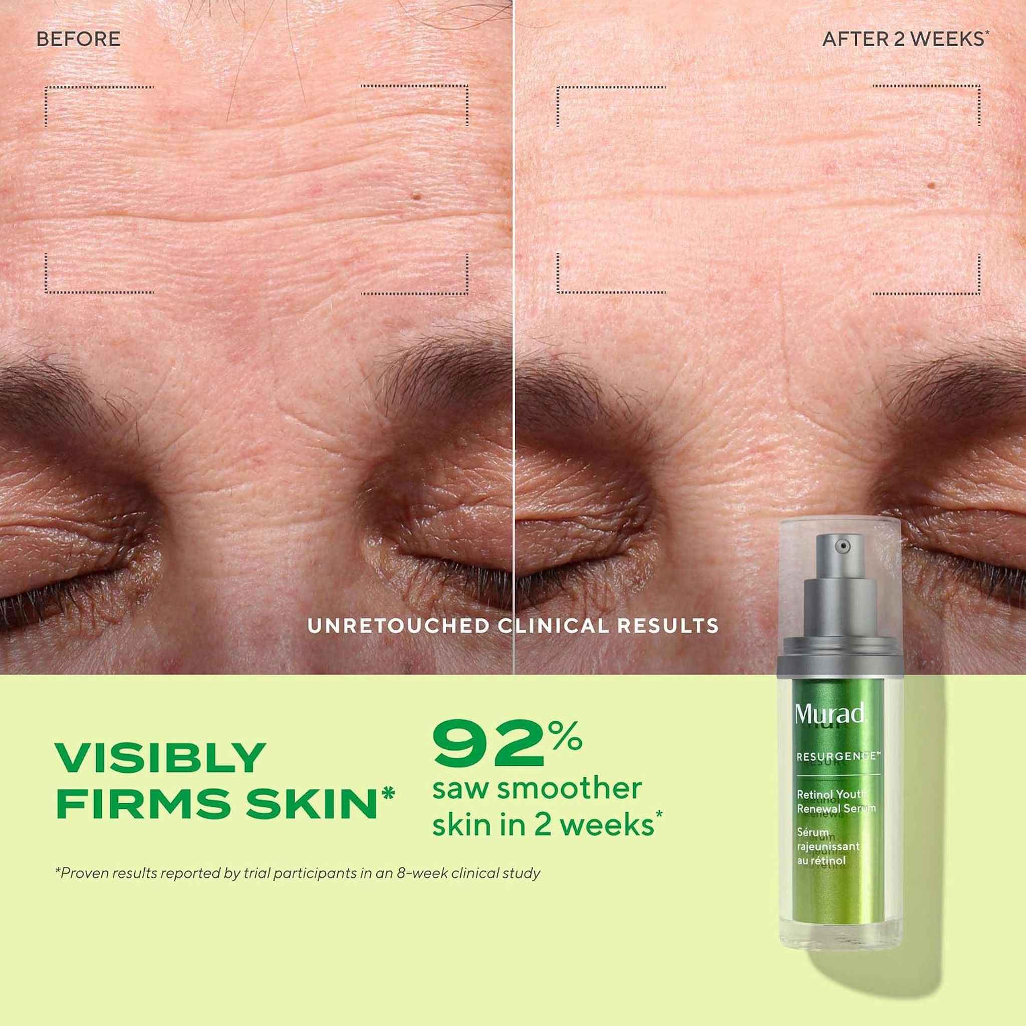 Unretouched before and after forehead wrinkle results in two weeks