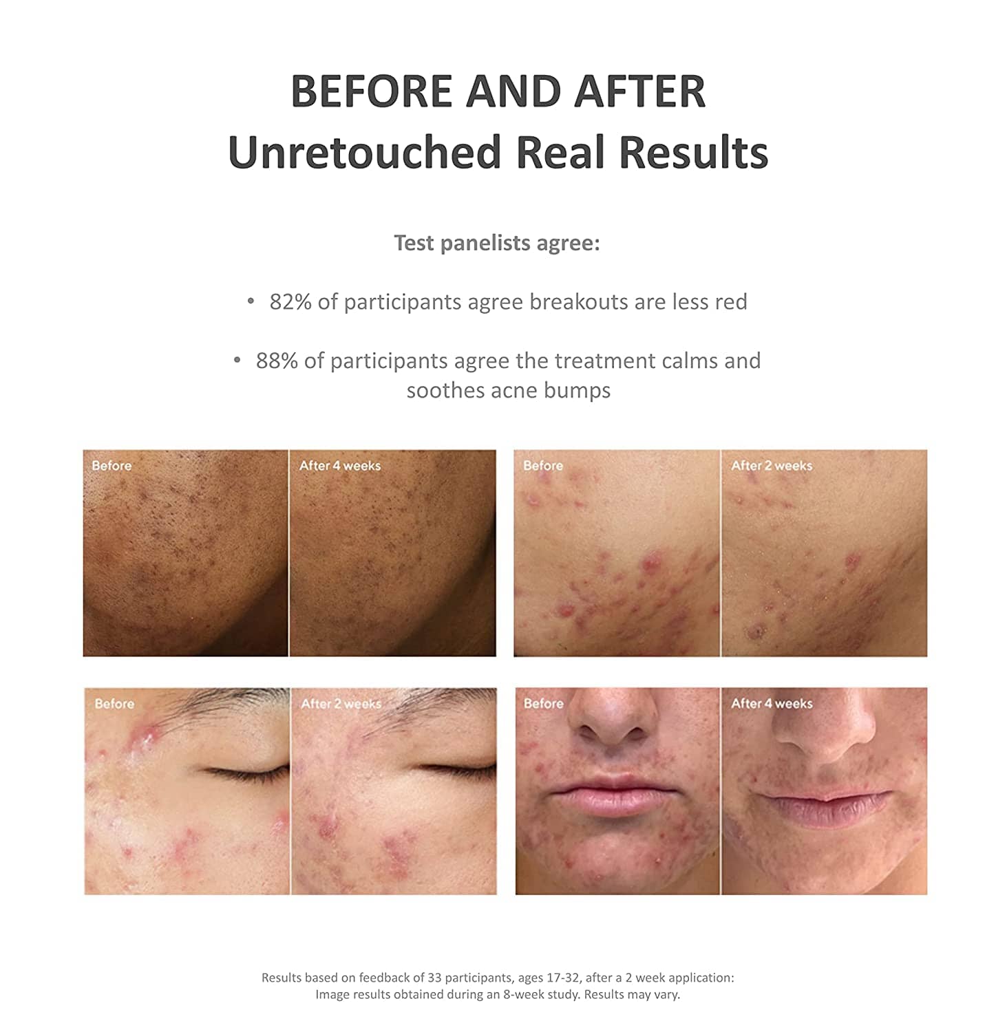 Murad Deep Relief Acne Treatment with 2% Salicylic Acid Murad Shop at Exclusive Beauty