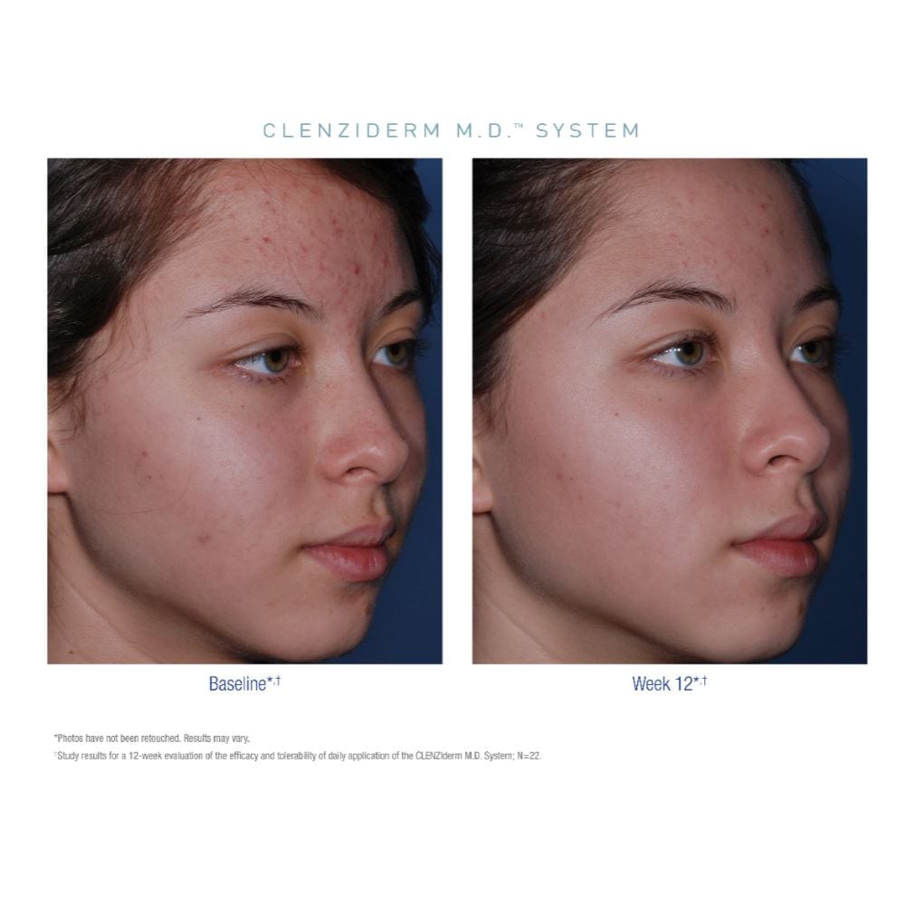 Obagi CLENZIderm M.D. System Obagi Shop at Exclusive Beauty