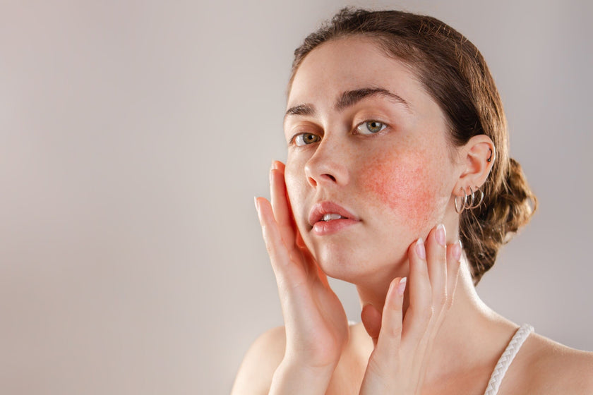 8 der besten Hautpflegeinhaltsstoffe zur Beruhigung von Entzündungen und Rötungen