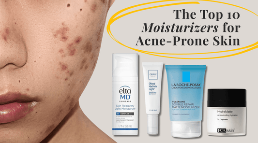 The Top 10 Moisturizers for Acne-Prone Skin - Exclusive Beauty Club