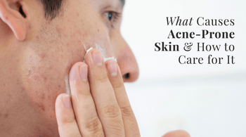 What Causes Acne-Prone Skin and How to Care for It Read Skincare blog at Exclusive Beauty Club