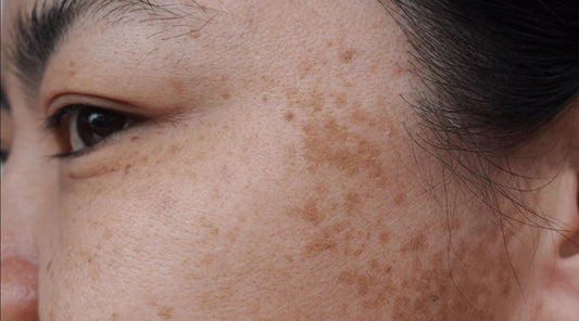 Dermatologist-Approved Melasma Treatments