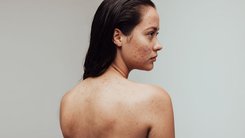 Différents types d'acné