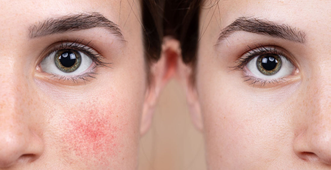 Rosacea & Our PA ~ Paula Lifestyle Tips