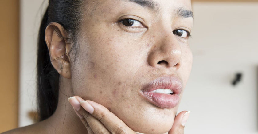 Dicas para prevenção da acne em adultos
