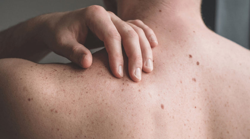 Was sind einige frühe Anzeichen von Hautkrebs?