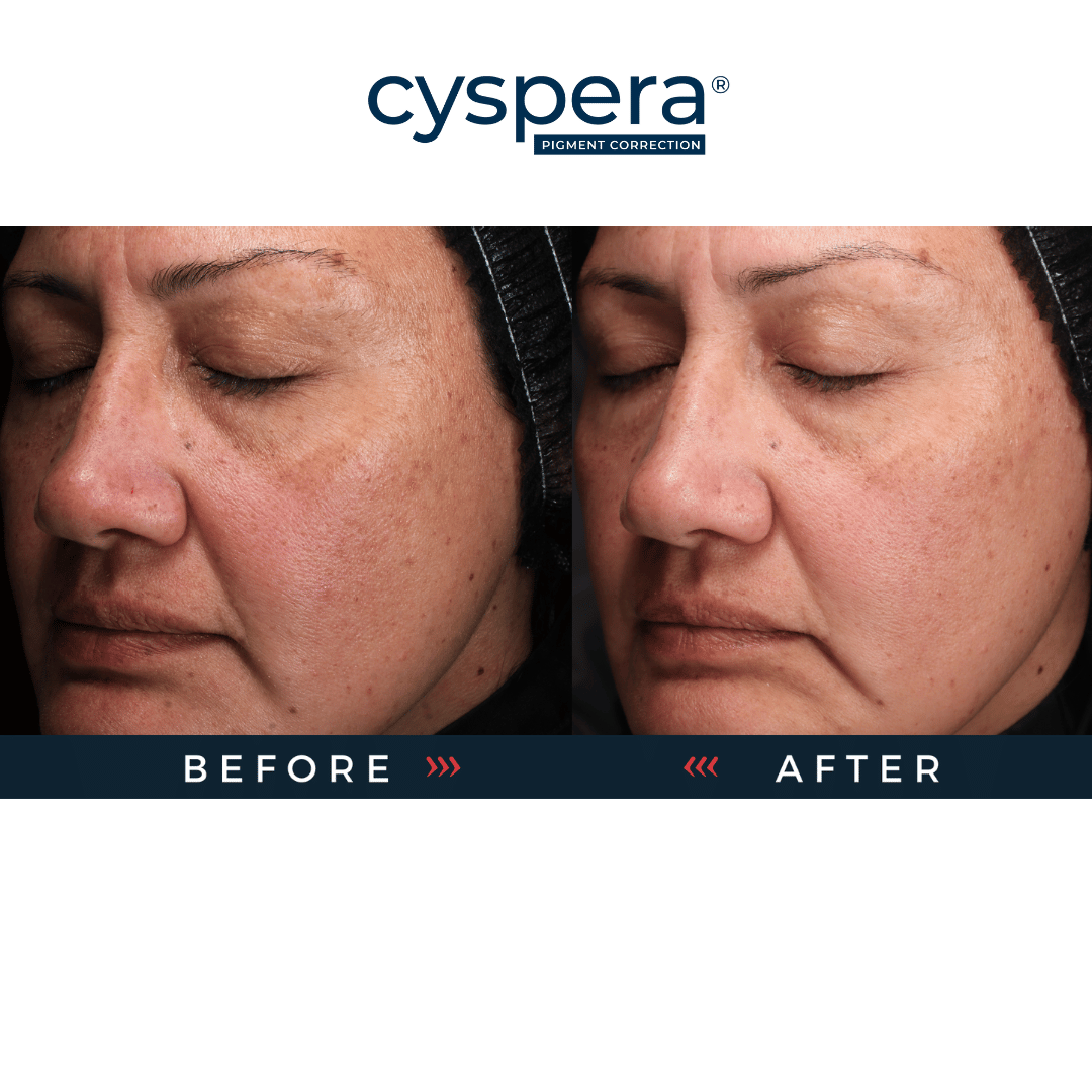 Cyspera Original+ Pigment Corrector | Brighten & Even Skin Tone Cyspera Original+ Pigment Corrector | Brighten & Even Skin Tone
