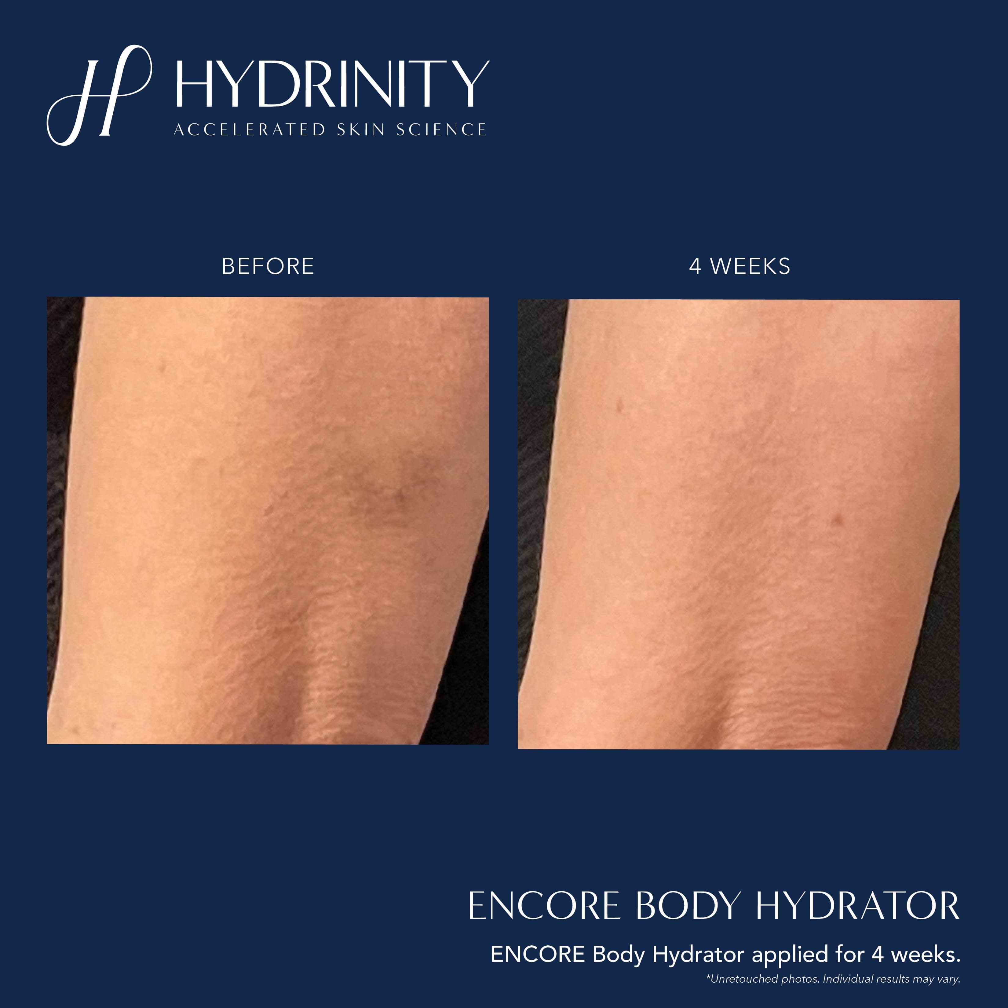 Hydrinity Encore Body Hydrator Before and After