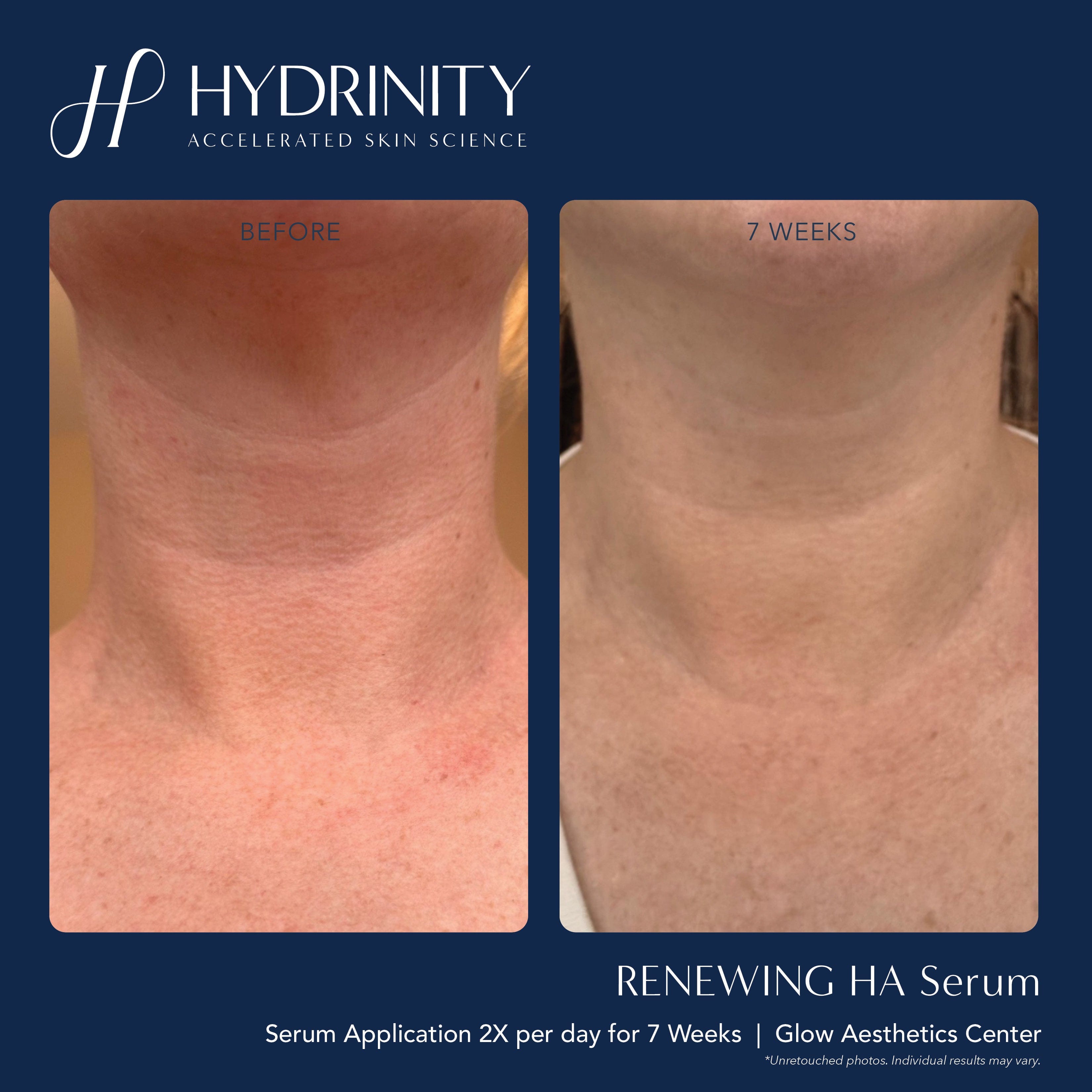 Hydrinity Renewing Serum Before and After