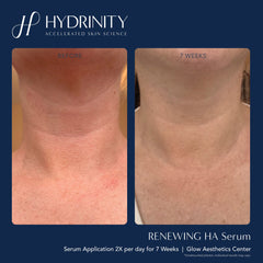 Hydrinity Renewing Serum Before and After