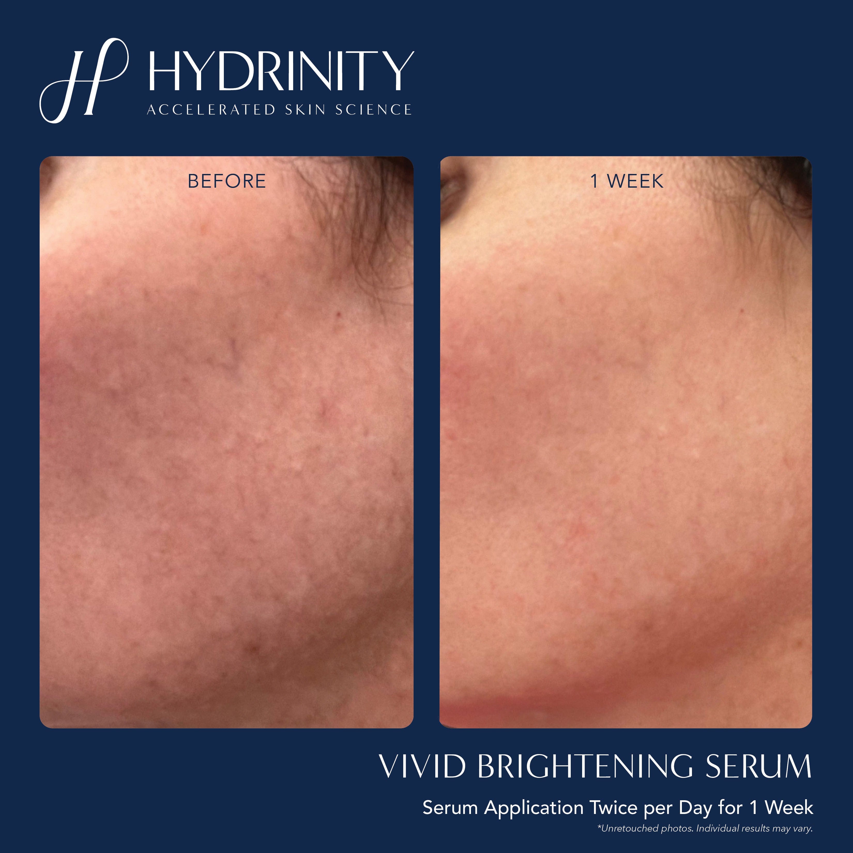 Before and After Vivid Brightening Serum Hydrinity