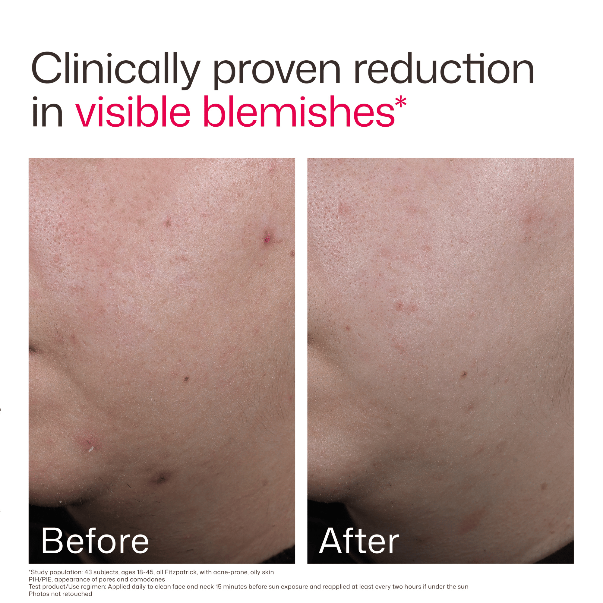 EltaMD UV Clear Acne Blemish-Prone & Oil Balancing SPF 50 lightweight sunscreen designed to protect acne-prone skin while reducing oil and visible blemishes. Available at Exclusive Beauty Club. Product Before and After.