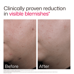 EltaMD UV Clear Acne Blemish-Prone & Oil Balancing SPF 50 lightweight sunscreen designed to protect acne-prone skin while reducing oil and visible blemishes. Available at Exclusive Beauty Club. Product Before and After.