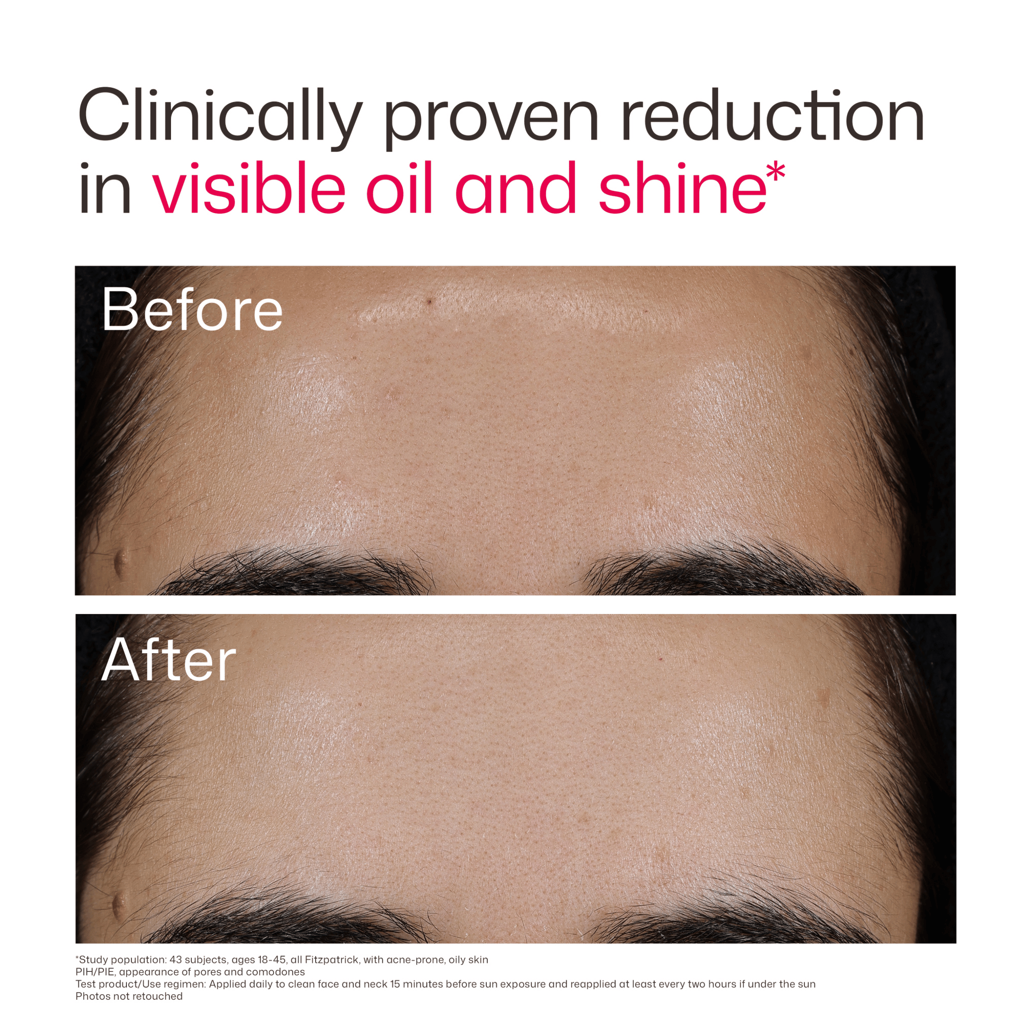 EltaMD UV Clear Acne Blemish-Prone & Oil Balancing SPF 50 lightweight sunscreen designed to protect acne-prone skin while reducing oil and visible blemishes. Available at Exclusive Beauty Club. Product Before and After.