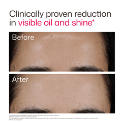 EltaMD UV Clear Acne Blemish-Prone & Oil Balancing SPF 50 lightweight sunscreen designed to protect acne-prone skin while reducing oil and visible blemishes. Available at Exclusive Beauty Club. Product Before and After.