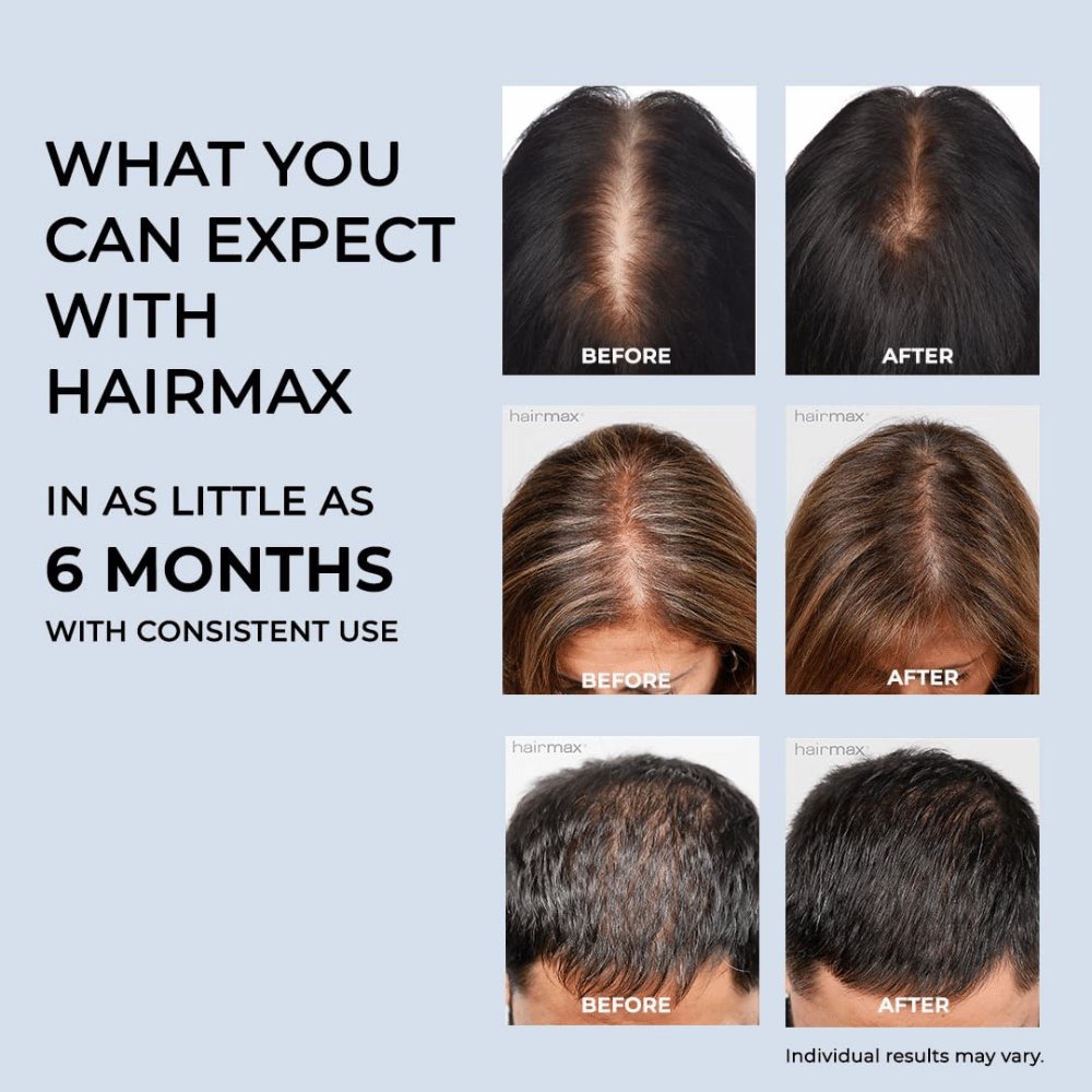Hairmax PowerFlex Laser Cap 272 | FDA-Cleared Hair Growth Solution Hairmax PowerFlex Laser Cap 272 | FDA-Cleared Hair Growth Solution
