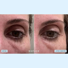 Before and after using NuFACE Hydra-Gel Power Patches showing reduced puffiness and smoother under-eyes