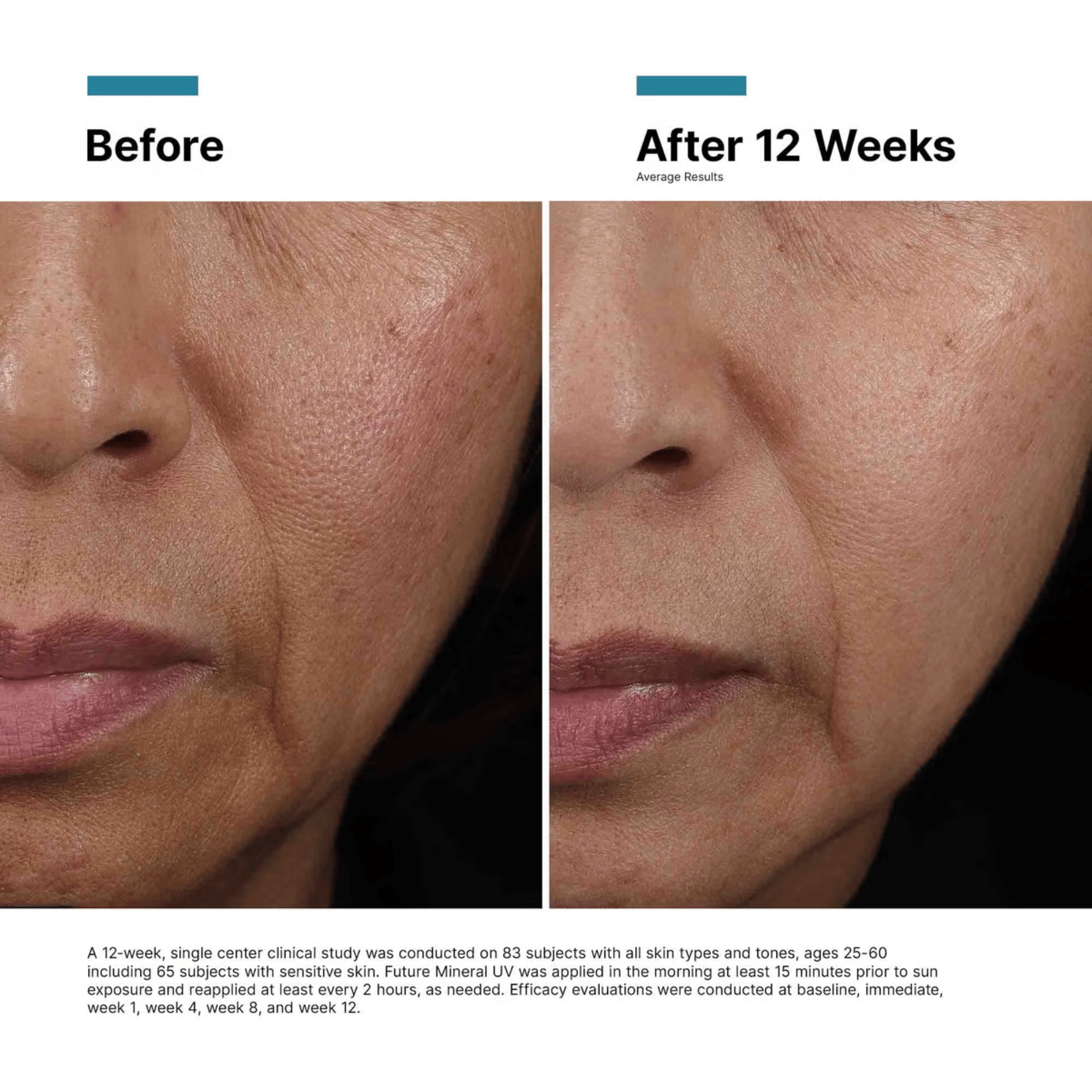 Before and after 12 weeks using SkinCeuticals Future Mineral UV Defense SPF 50, showing improved skin texture and tone. Available at Exclusive Beauty Club