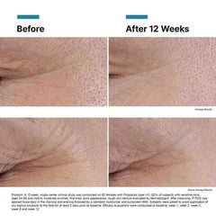 SkinCeuticals P-TIOX Before & After Images