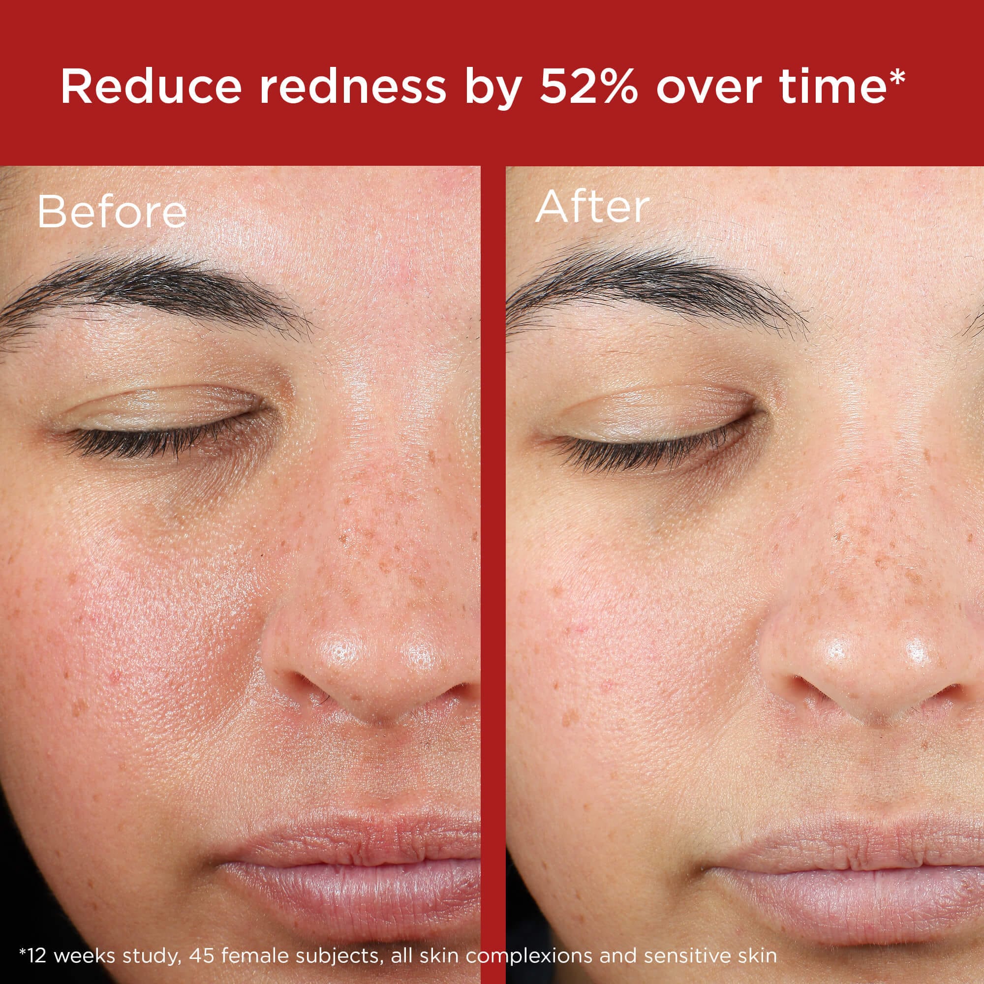 Before and after comparison of a woman's face with reduced redness, shown over time.