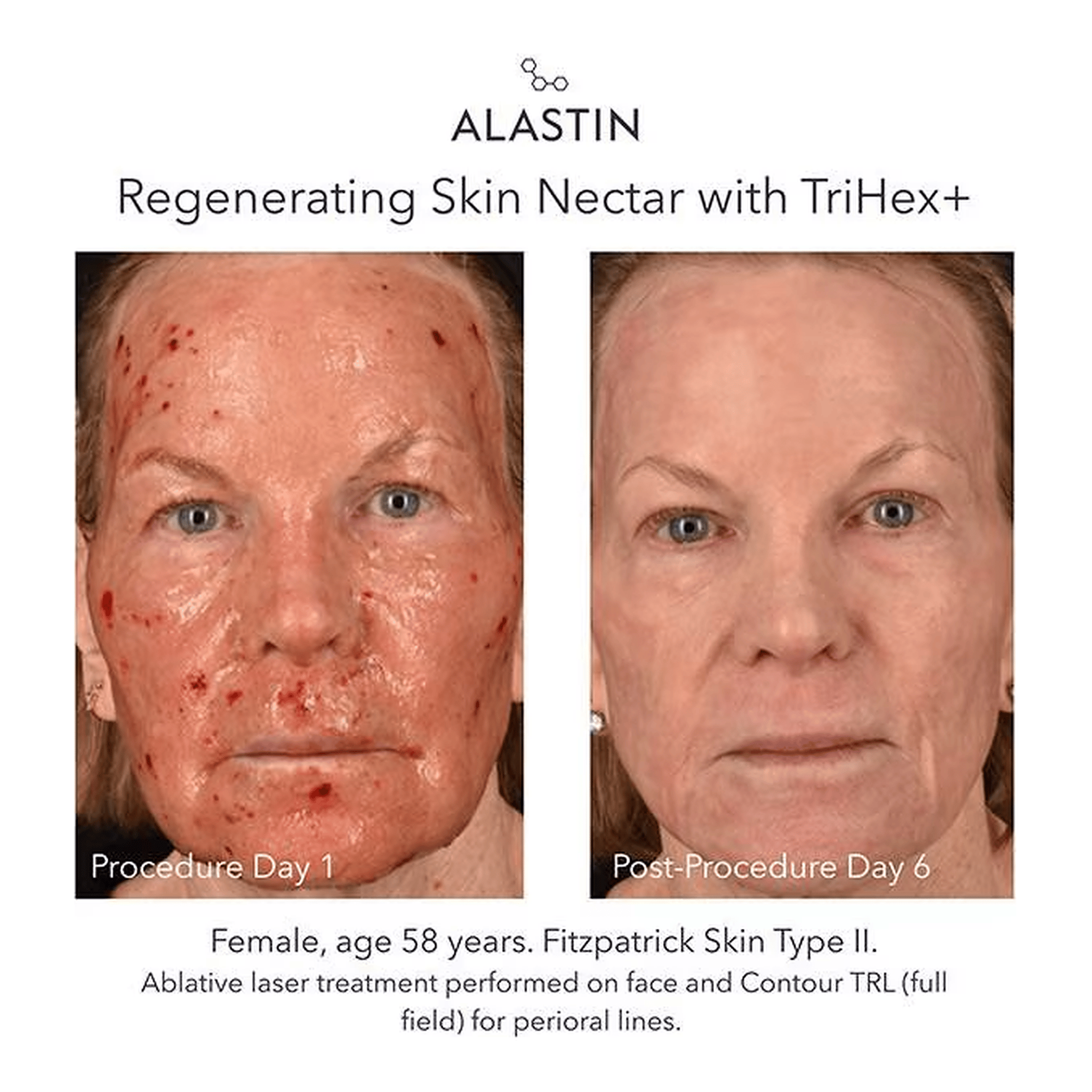 Alastin Regenerating Skin Nectar with TriHex+ before and after ablative laser showing skin recovery by day 6