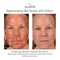 Alastin Regenerating Skin Nectar with TriHex+ before and after ablative laser showing skin recovery by day 6