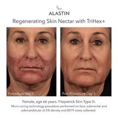 Alastin Regenerating Skin Nectar with TriHex+ before and after micro coring procedure showing recovery by day 3