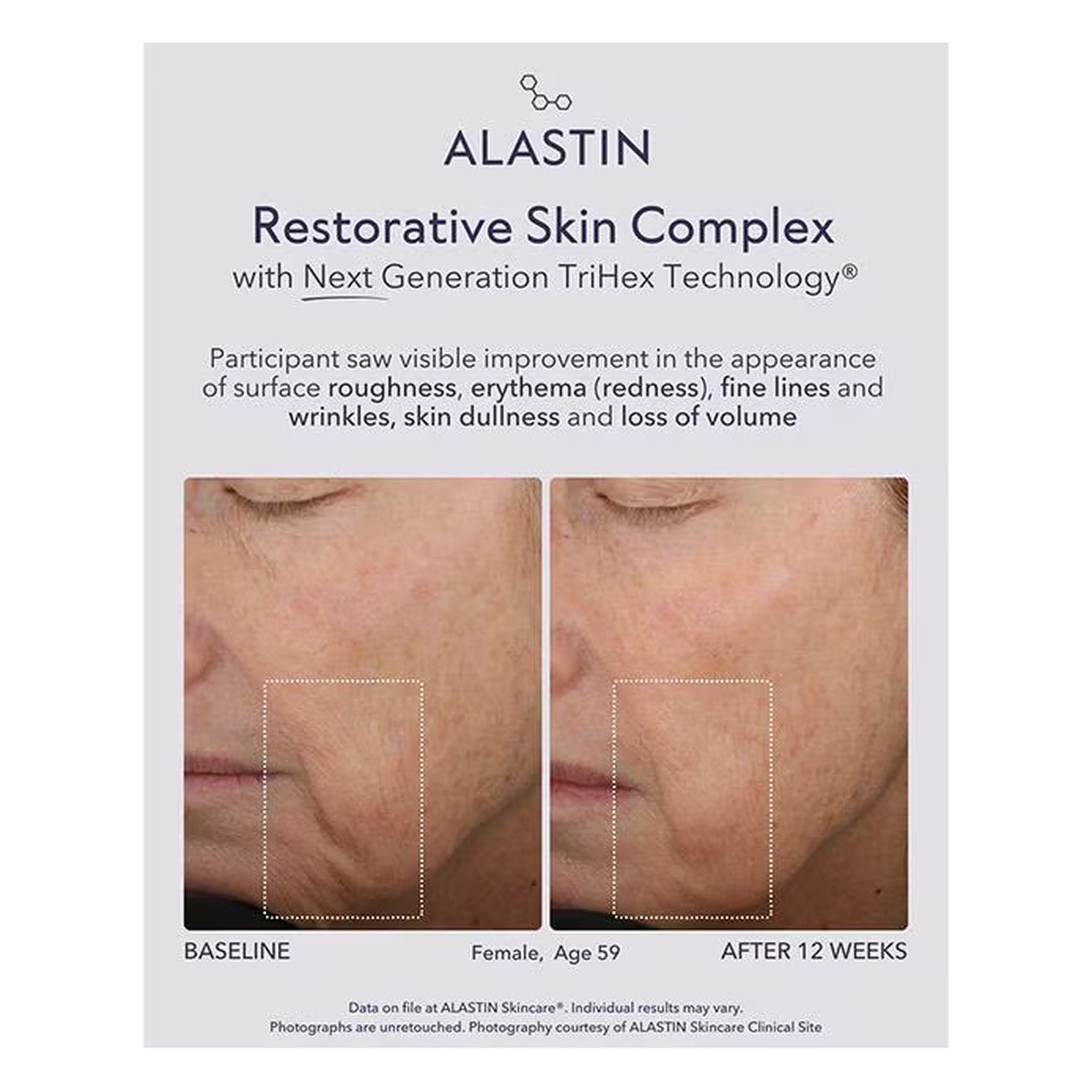 ALASTIN Restorative Skin Complex before and after 12 weeks showing smoother firmer skin