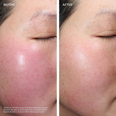 Before and after comparison of skin texture on a person's face.