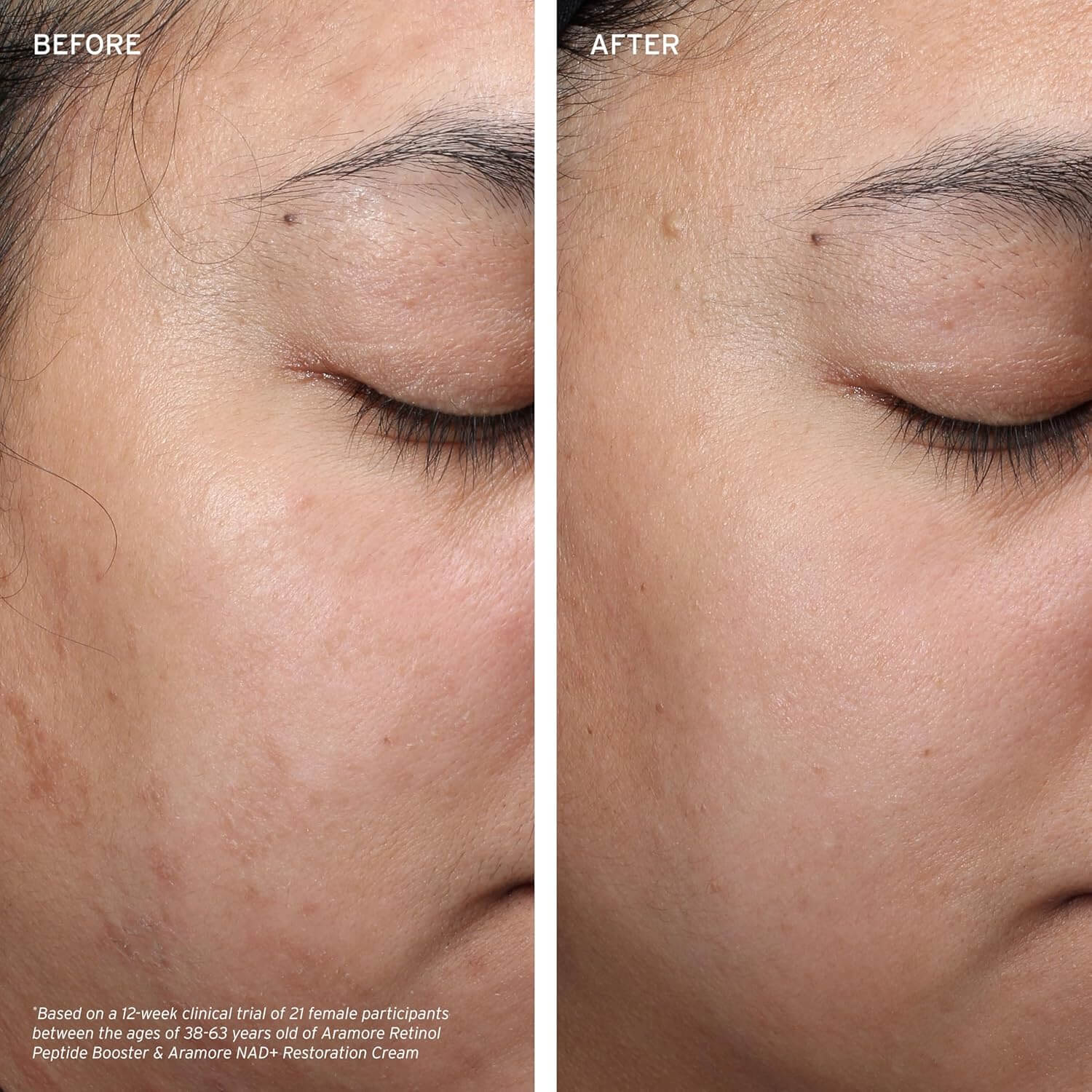 Before and after comparison of a woman's eye area with visible skin improvement.