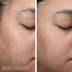 Before and after comparison of a woman's eye area with visible skin improvement.