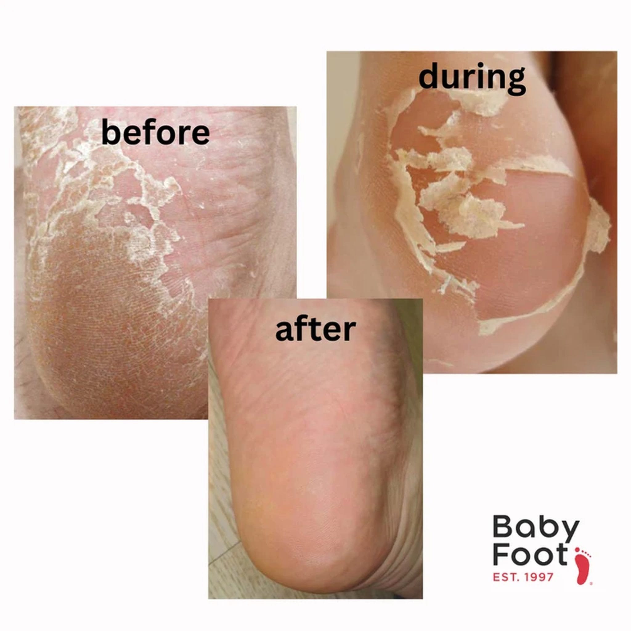 Baby Foot Original Foot Peel before during and after results