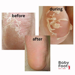 Baby Foot Original Foot Peel before during and after results