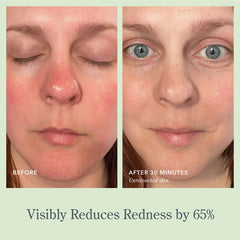 Before and after photos showing 65% visible redness reduction after 30 minutes