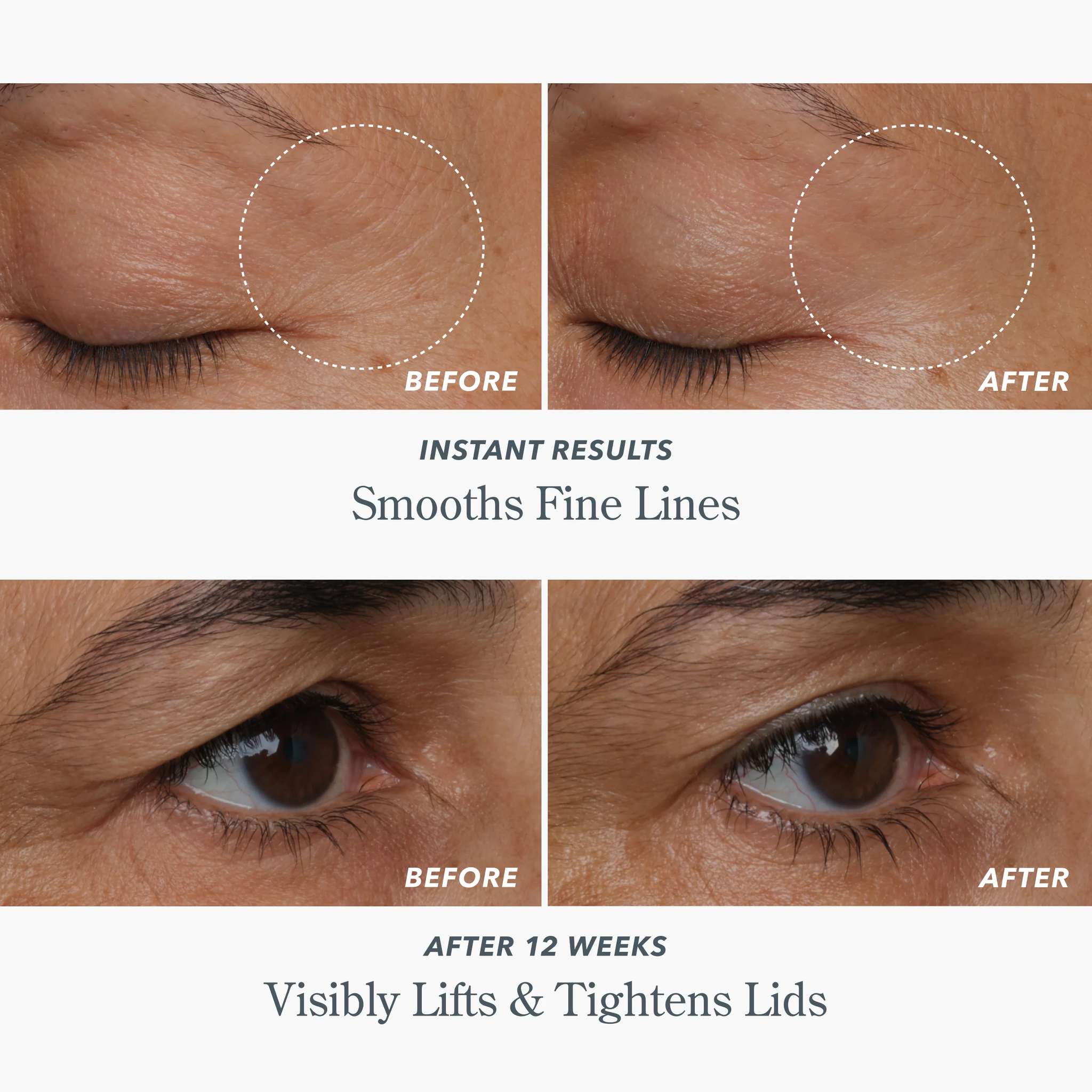 Before and after photos showing smoothed fine lines and lifted tightened eyelids
