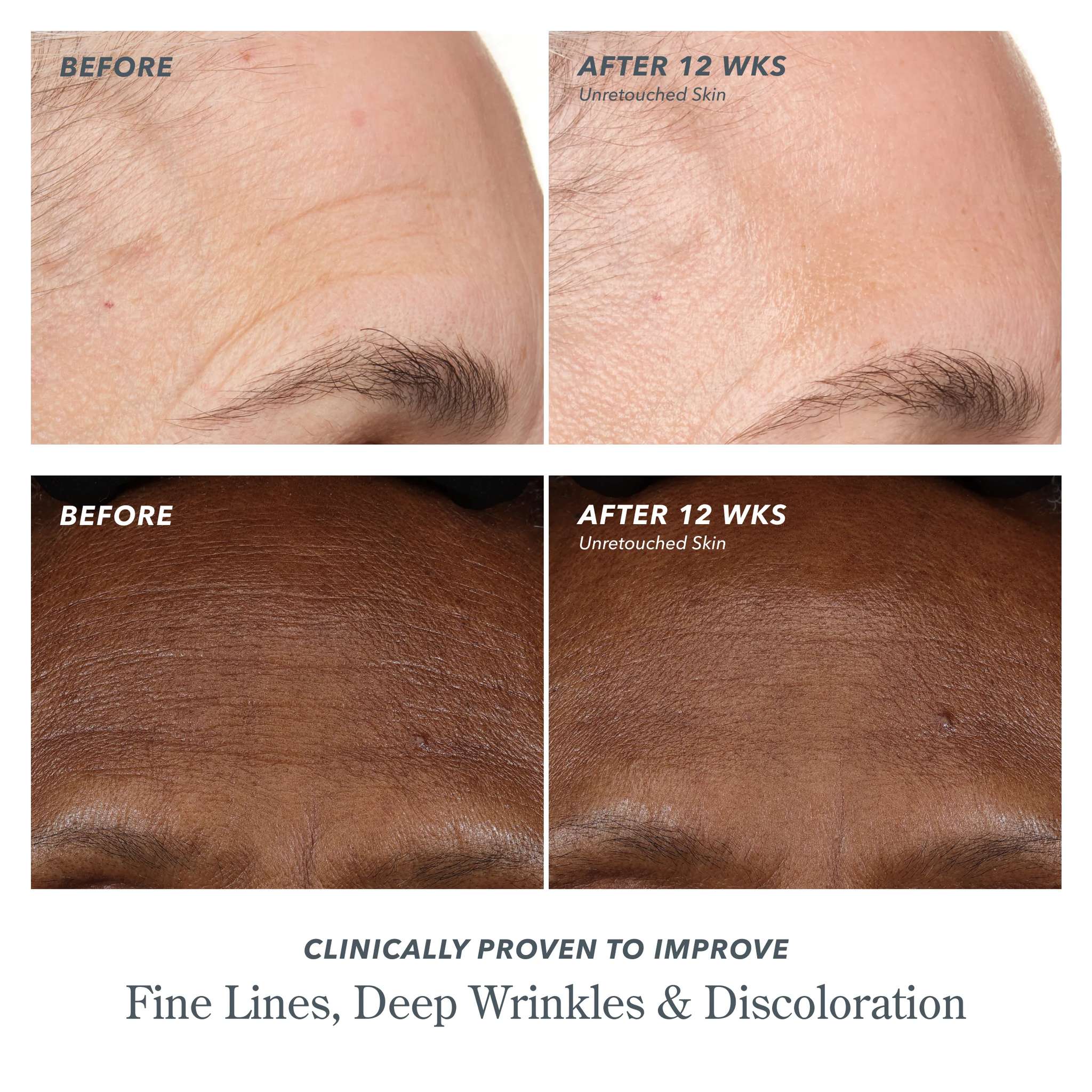Before and after forehead photos showing improved fine lines and discoloration after 12 weeks