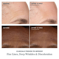Before and after forehead photos showing improved fine lines and discoloration after 12 weeks