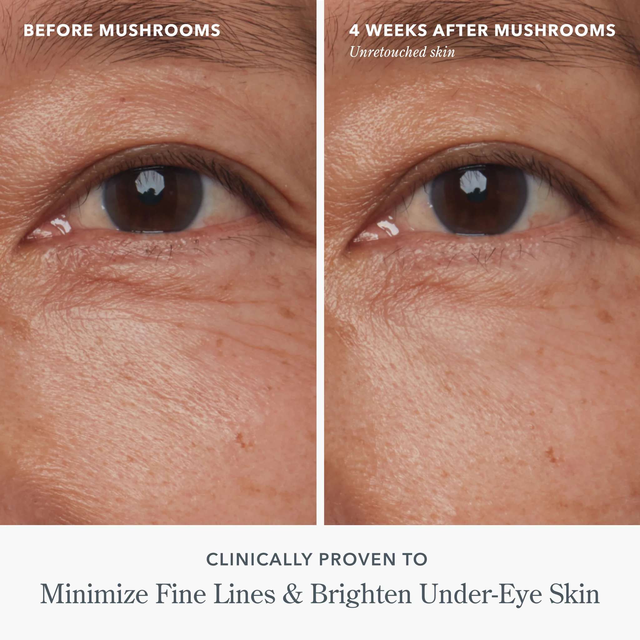 Before and after eye photos showing re-awakened tired eyes after 4 weeks