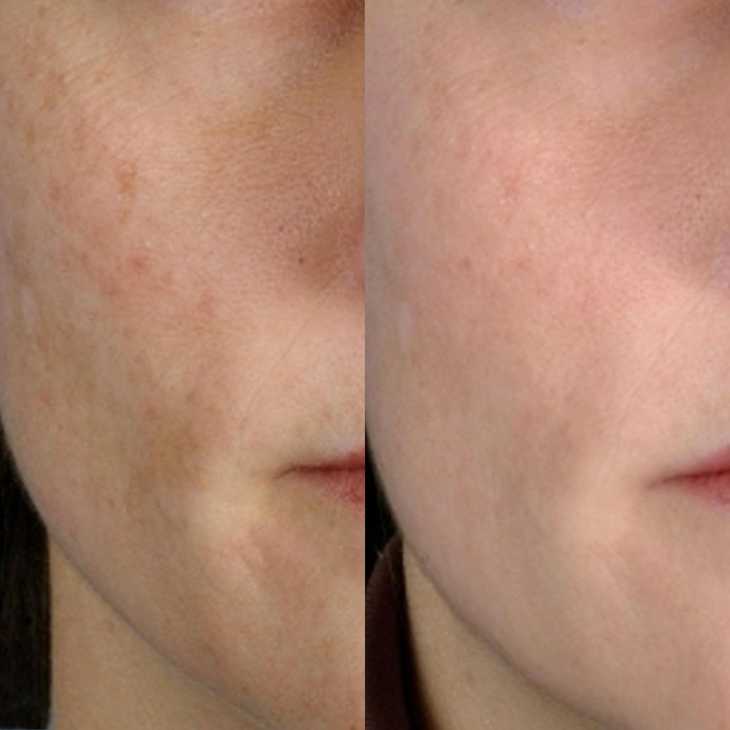 PMD Personal Microderm Classic Berry 4