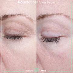 Before and after close-up showing reduced eye area wrinkles and fine lines after using BIOEFFECT EGF Power Serum