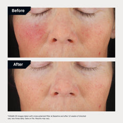 Before and after comparison of skin with acne treatment showing improvement.