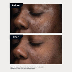 Before and after comparison of a person's skin with visible improvement.