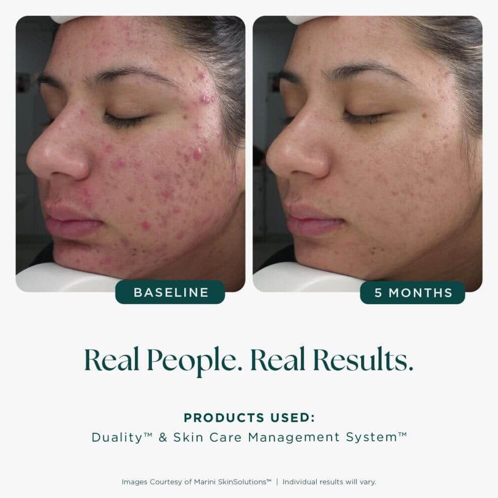 Before and after comparison of a person's face with acne, showing results after 5 months using skincare products.