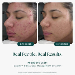 Before and after comparison of a person's face with acne, showing results after 5 months using skincare products.