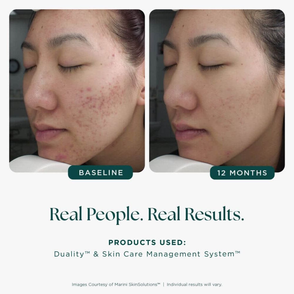 Before and after comparison of a person's face with acne, showing improvement over 12 months. Text indicates 'Real People.