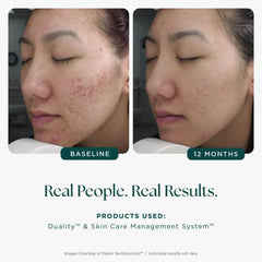 Before and after comparison of a person's face with acne, showing improvement over 12 months. Text indicates 'Real People.